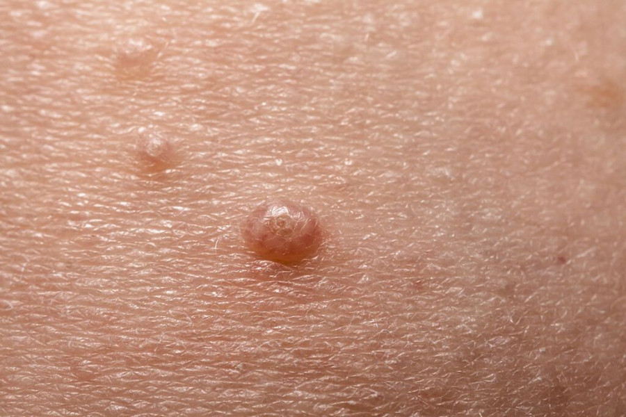 Παγκόσμια Ημέρα HPV: Συμπτώματα, κίνδυνοι & αντιμετώπιση του ιού των ανθρωπίνων θηλωμάτων εικόνα 2