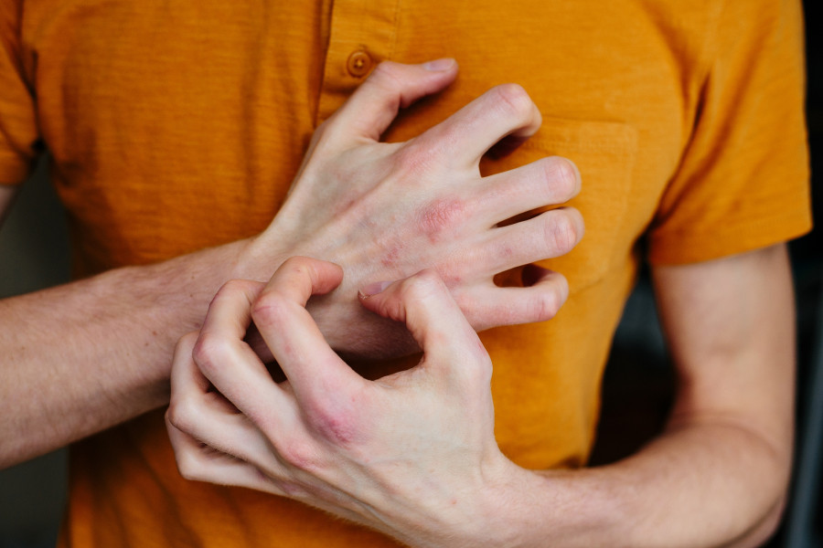 Psoriasis-Eczema-dermatitis-psoriasi-ekzema-ksirodermia-dermatitida
